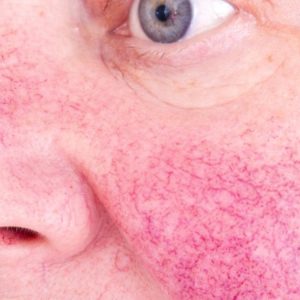 I see red… is it Rosacea?