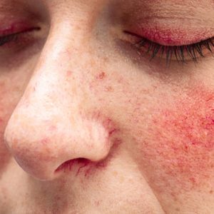 Facing Rosacea head on