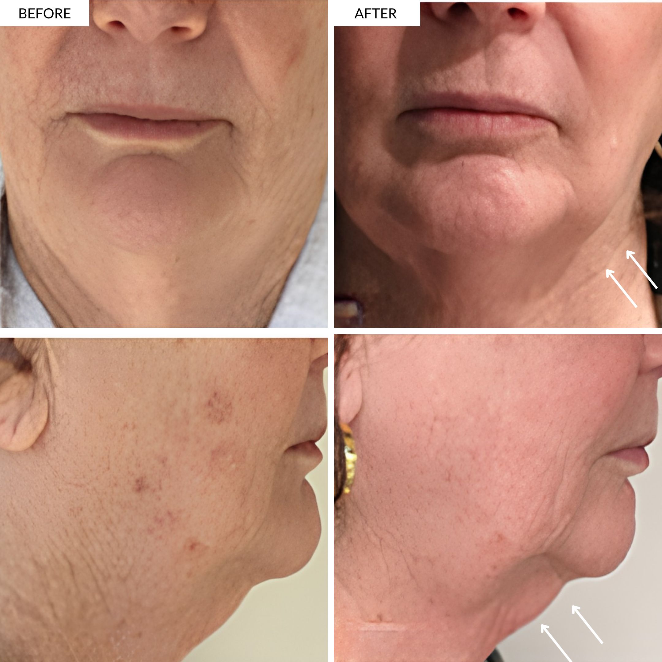 Chin and jawline more defined and lifted. Skin is  more lustrous and healthier.