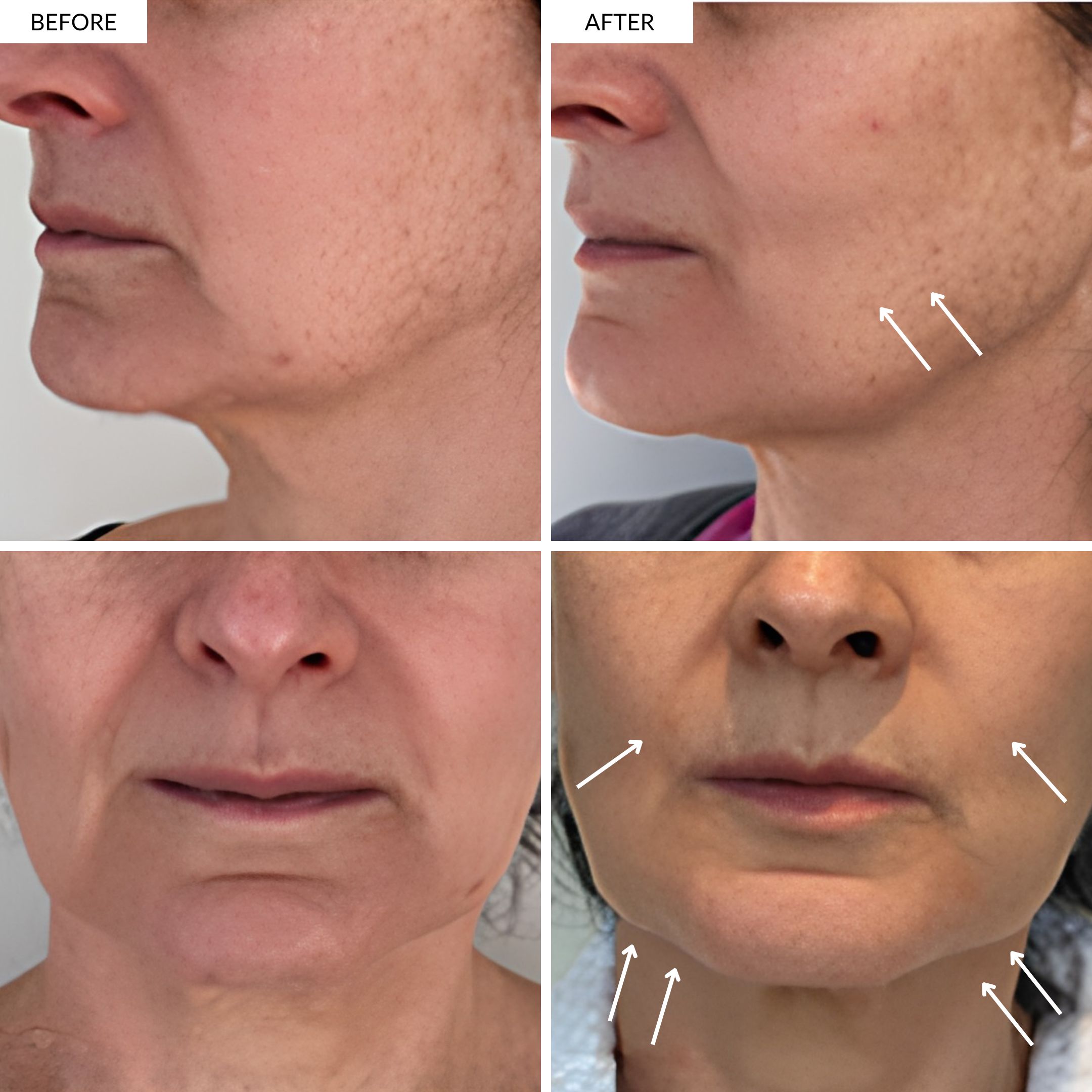 Lifting effect on the jawline and naso-labial folds. Cheeckbones more defined. Testure is smoother and uneven pigmentation is reduced.