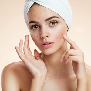 Can facials cure acne for good?