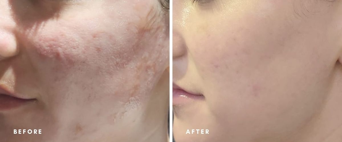 skin needling before and after at Temple Skincare & Spa