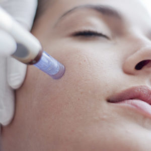 Skin needling: The secret to looking noticeably youthful