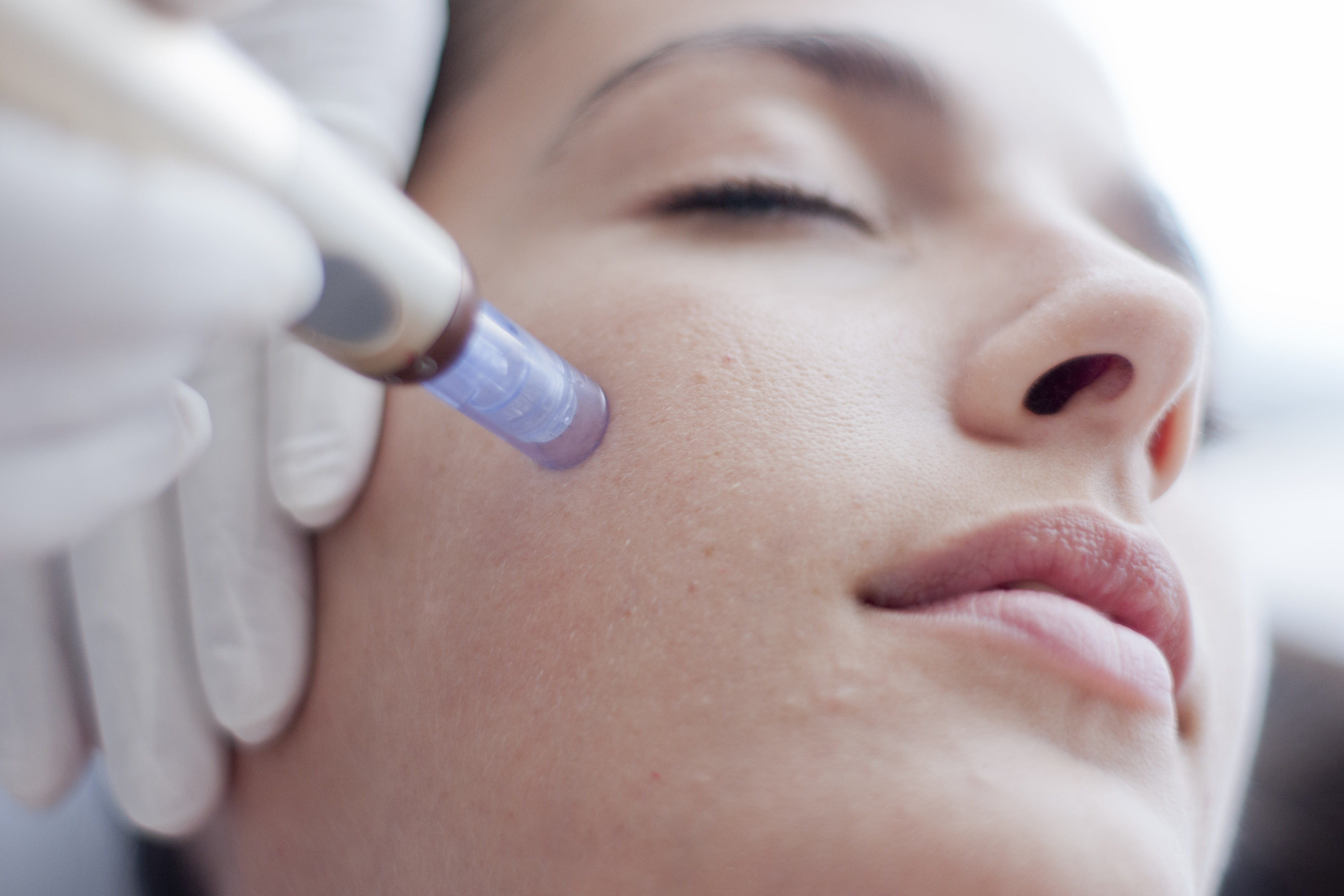 Skin needling: The secret to looking noticeably youthful Skin needling: The secret to looking noticeably youthful