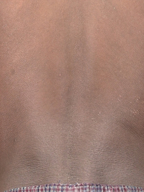 LED after pigmentation 2