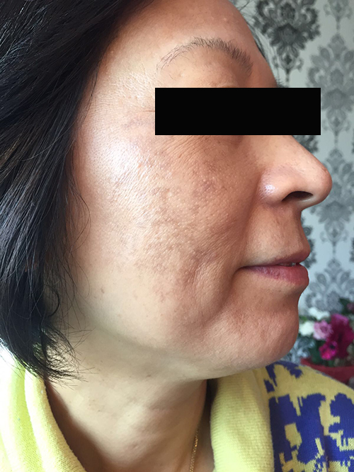 LED after pigmentation