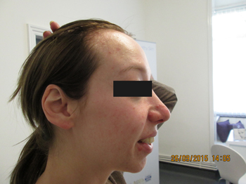 LED after red and blemished skin