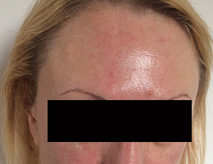 LED after red and blemished skin 2