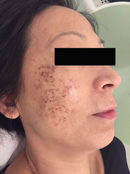LED before pigmentation