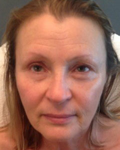 LED before skin rejuvenation 2