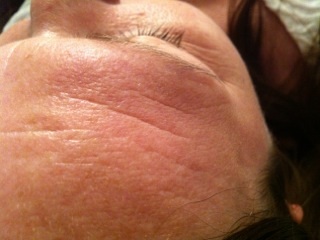 LED before skin rejuvenation