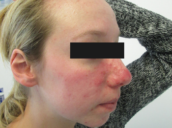 LED before red and blemished skin