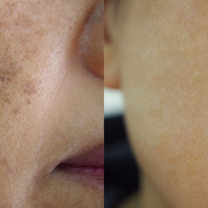 How can I get rid of skin pigmentation?