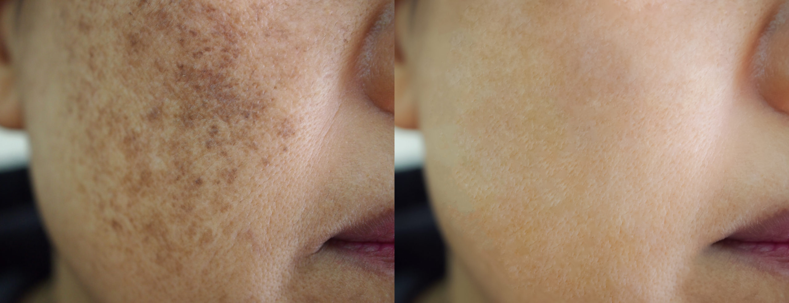 How can I get rid of skin pigmentation?