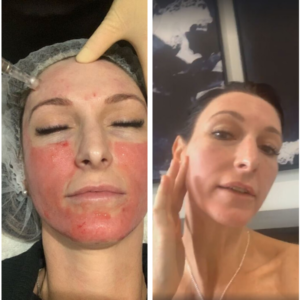 How often can I have skin needling?