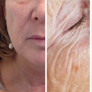 What is HIFU lifting and how can it help you look younger?