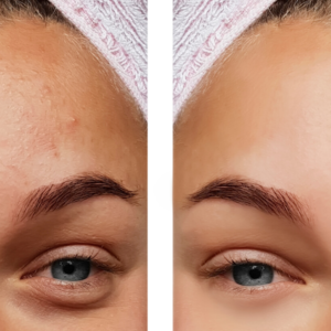 What is the cause of acne and what can you do about it?