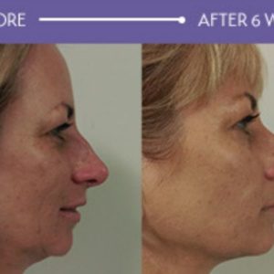 Medispa Lifting with HIFU, Sydney NSW