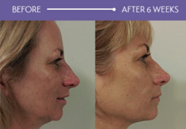 Medispa Lifting with HIFU, Sydney NSW