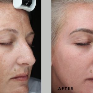 NEW! Goodbye Dark Patches! Chloasma and Melasma Depigmentation Programme at Temple Skincare & Spa