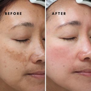 How do I get rid of dark spots on my face?