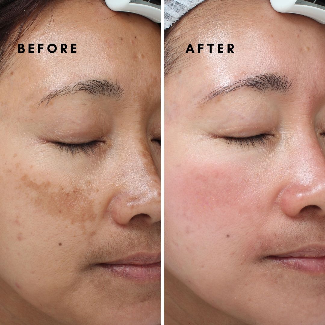 How do I get rid of dark spots on my face?