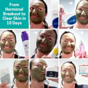 From Hormonal Breakout to Clear Skin in 10 Days