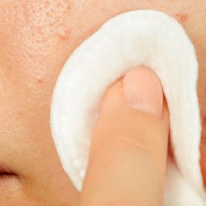 Adult Acne and Teenage Acne Causes and Treatment… the Struggle is Real!