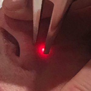 Broken Capillaries, Spider Veins, Visible Vessels and Sun Spots Laser Treatment