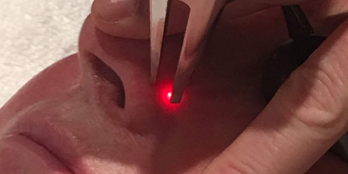 Broken Capillaries, Spider Veins, Visible Vessels and Sun Spots Laser Treatment Broken Capillaries, Spider Veins, Visible Vessels and Sun Spots Laser Treatment