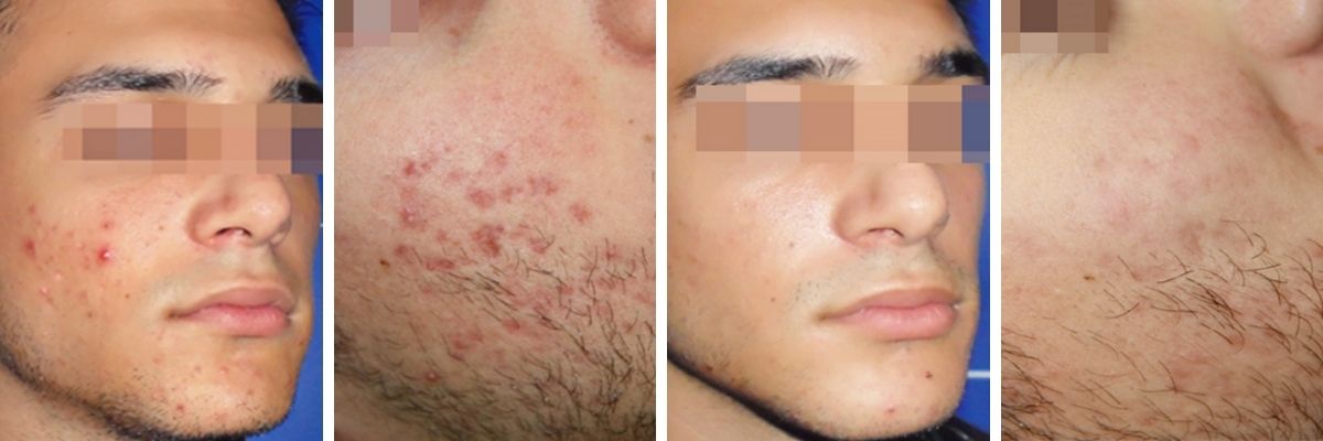 Acnelan treatment before and after temple skincare & spa