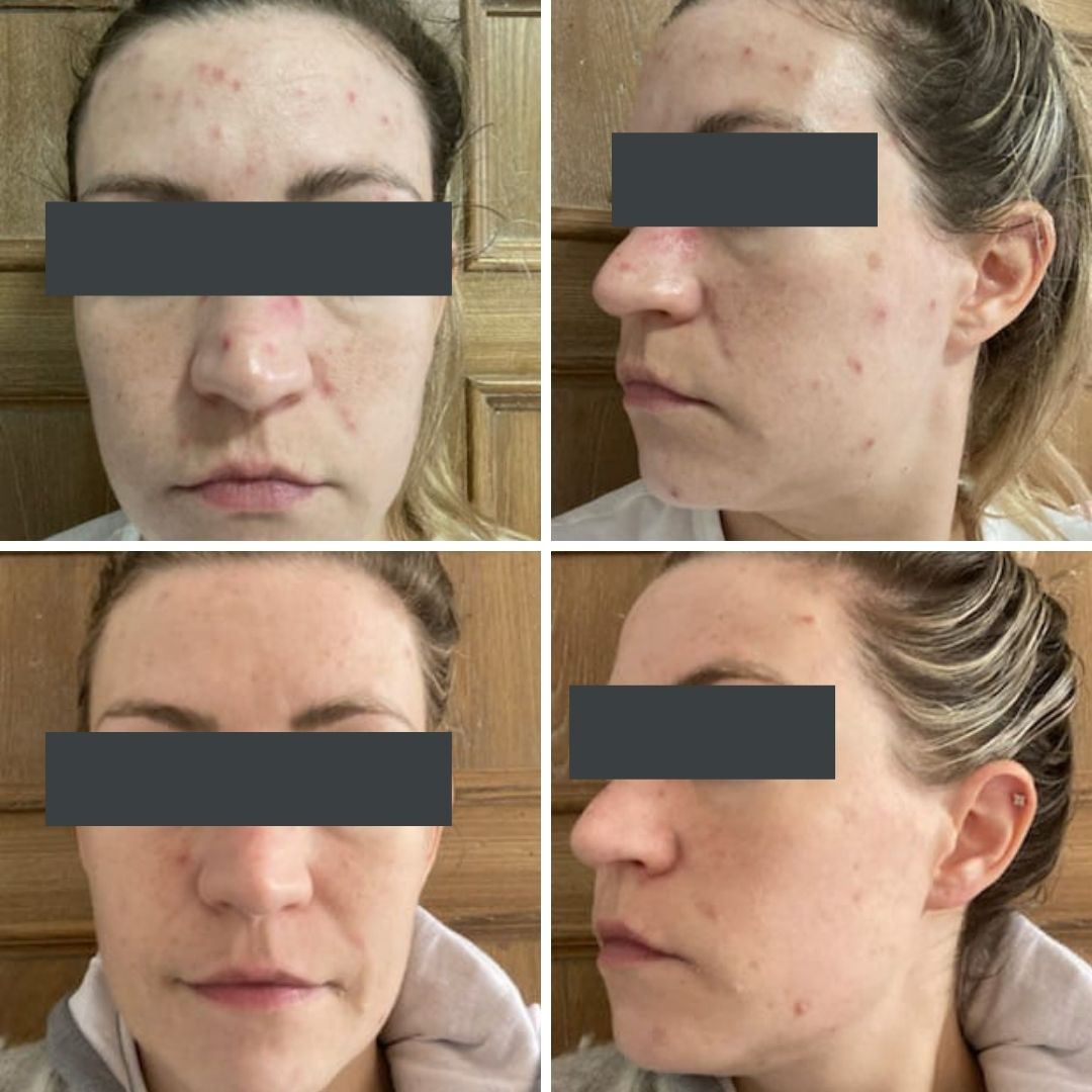 Acne treatment temple skincare & spa hills district sydney