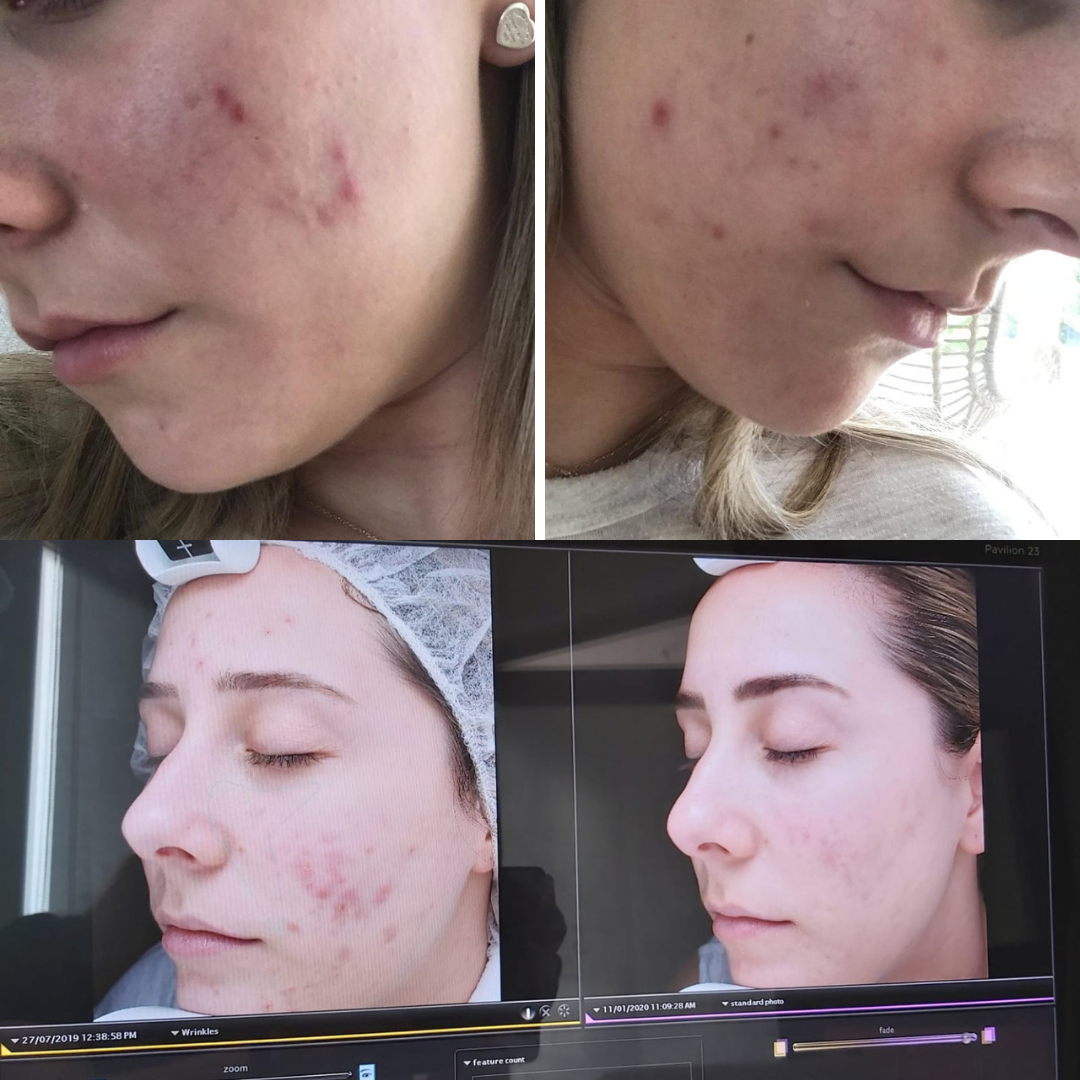 acne treatment program temple skincare & spa day spa medi spa sydney