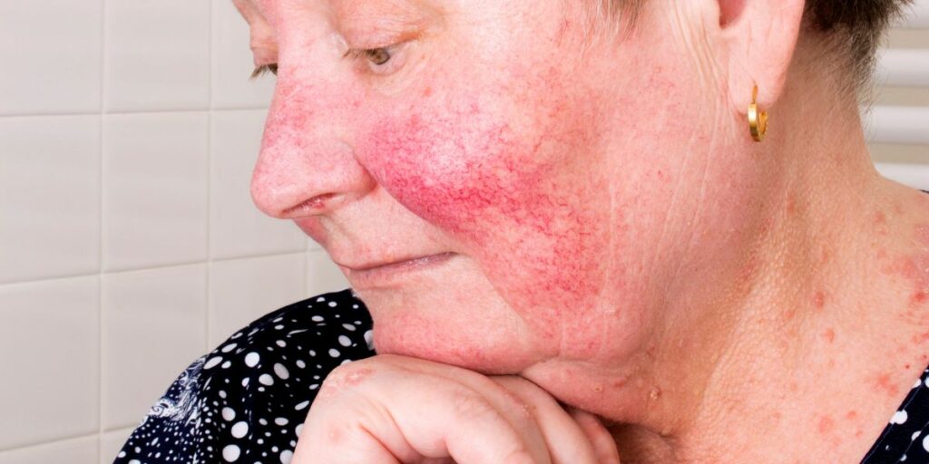 Rosacea Skin Care: Easy and Doable ways to calm, soothe and nurture Rosacea-prone skin