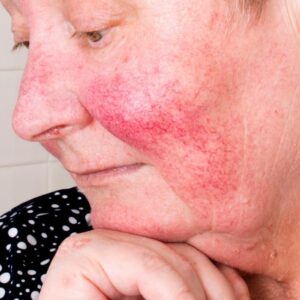 Rosacea Skin Care: Easy and Doable ways to calm, soothe and nurture Rosacea-prone skin