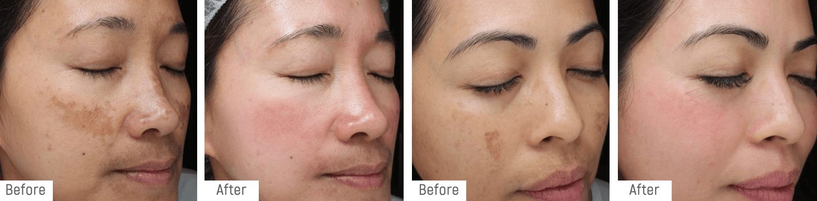 Temple clients at week 12 of Temple Depigmentation Program