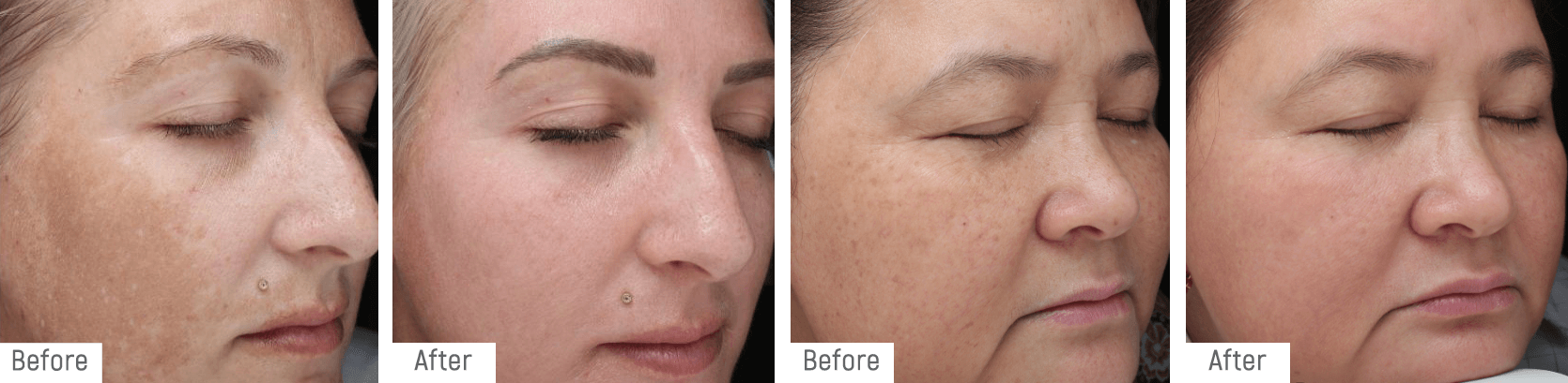 Temple clients at week 12 of Temple Depigmentation Program