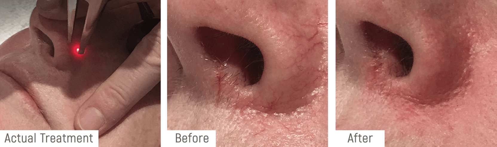 Single ND Yag Laser Treatment for broken capillaries. Immediate post-treatment results.