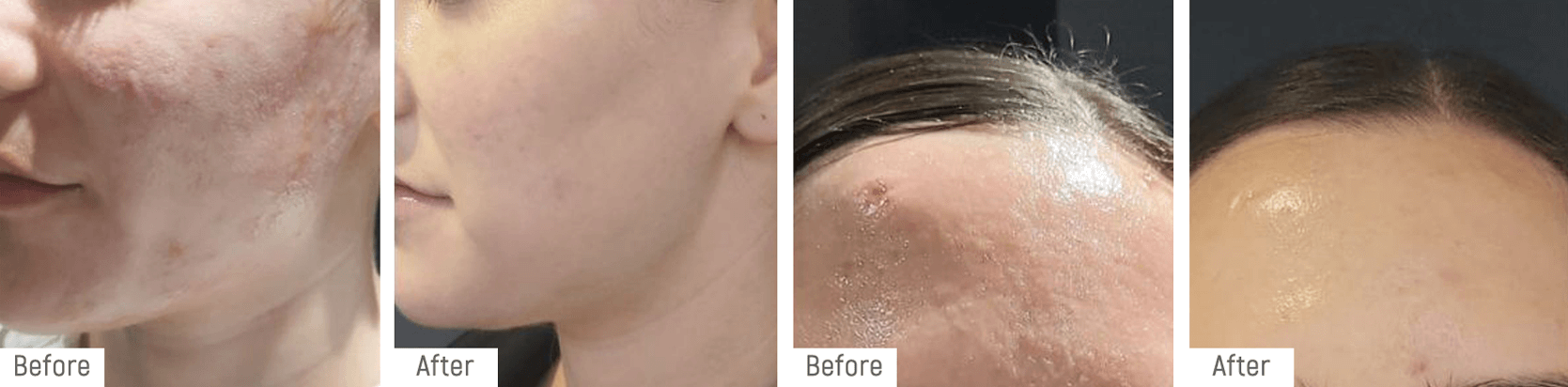 skinneedling-beforeafter1