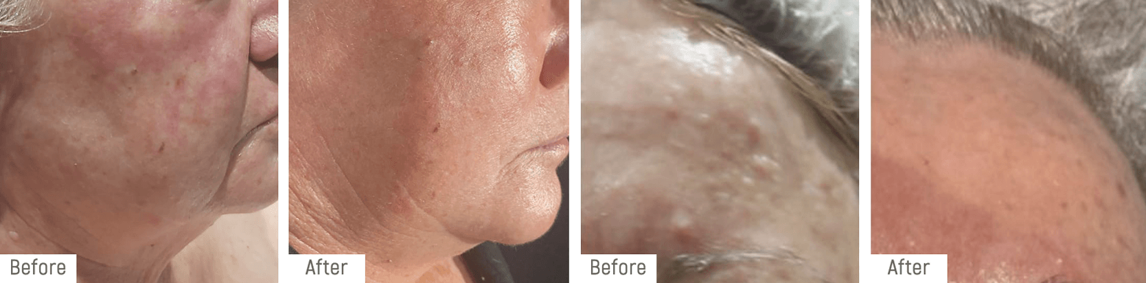 skinneedling-beforeafter2