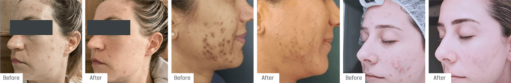 Temple clients in various stages of their Acne Treatment Programme