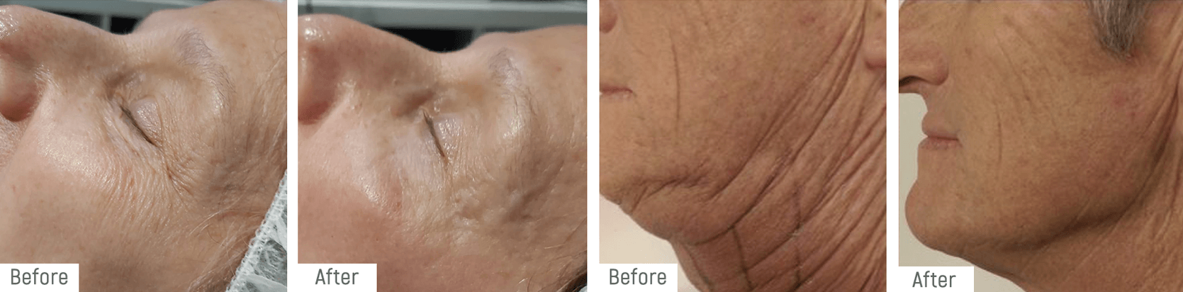 hifu-beforeafter1