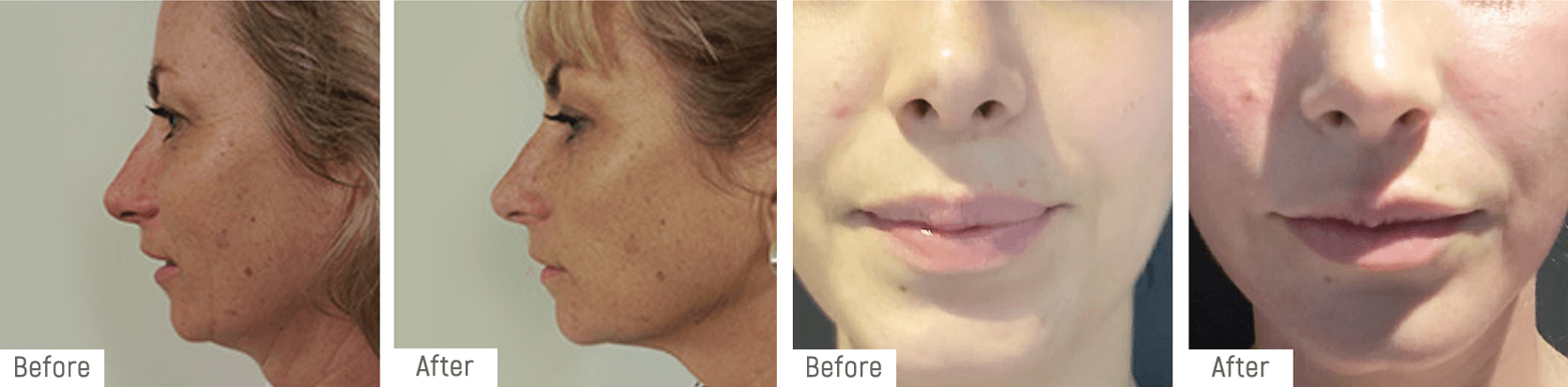 hifu-beforeafter2