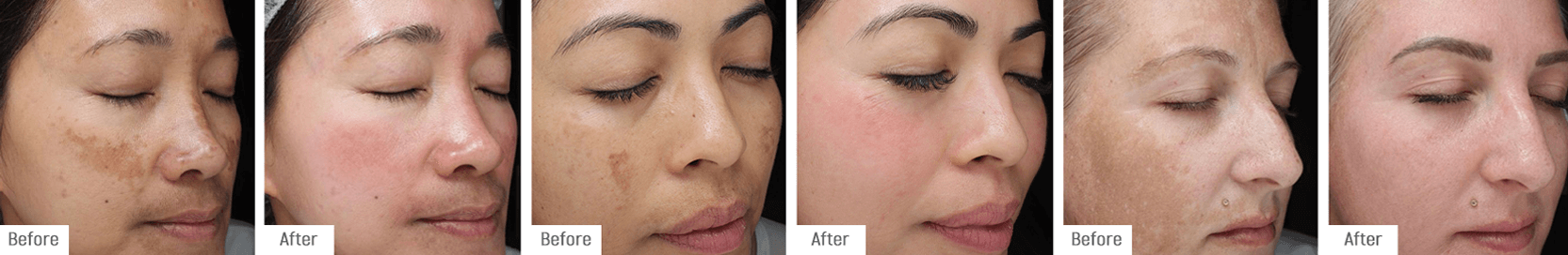 12-week Cosmelan Depigmentation Programme results