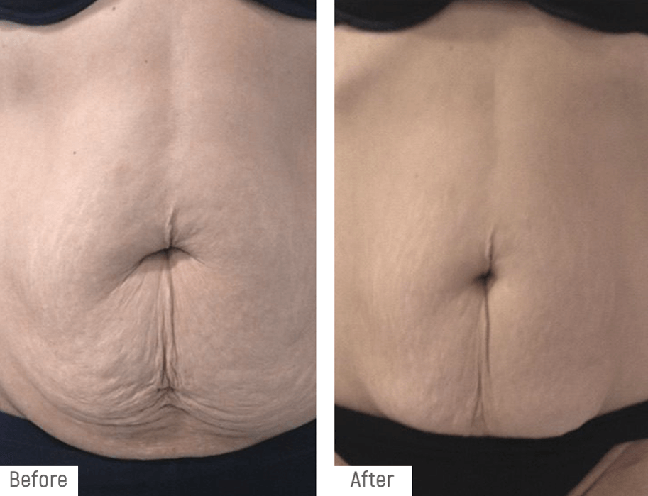 RadioFrequency Body Smoothing
