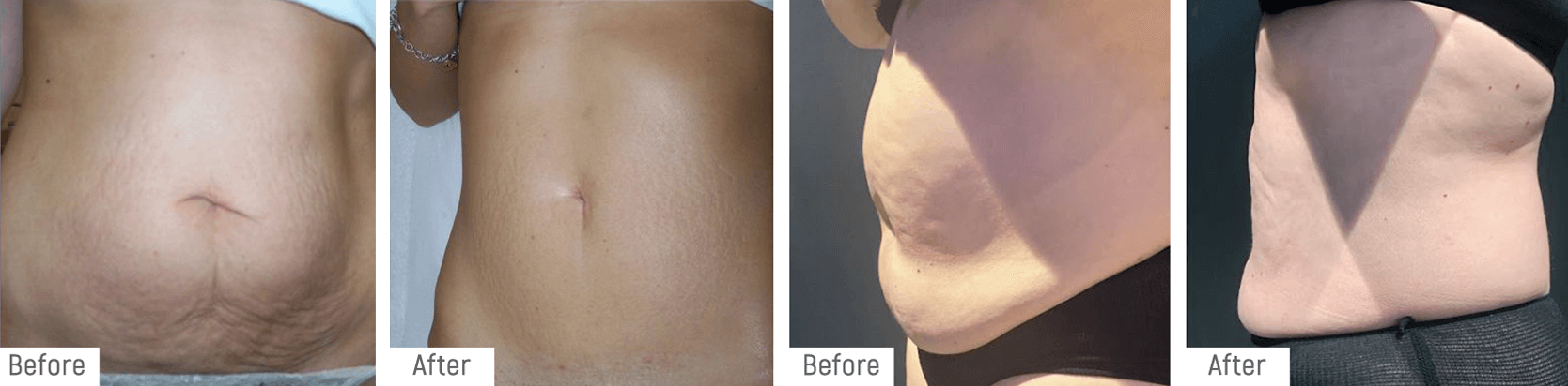fatfreezing-beforeafter1