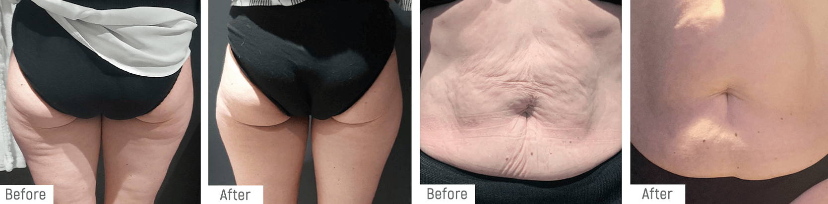 Before and After  Fat Freezing treatment