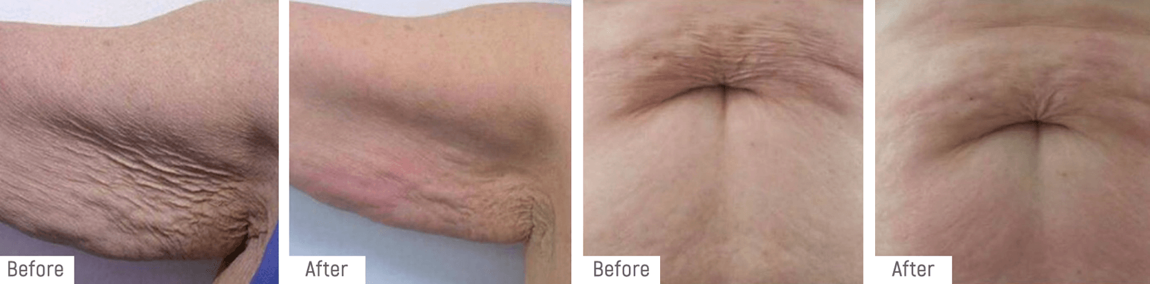 hifu-beforeafter
