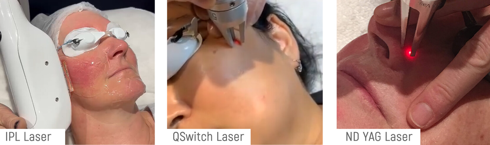 laser