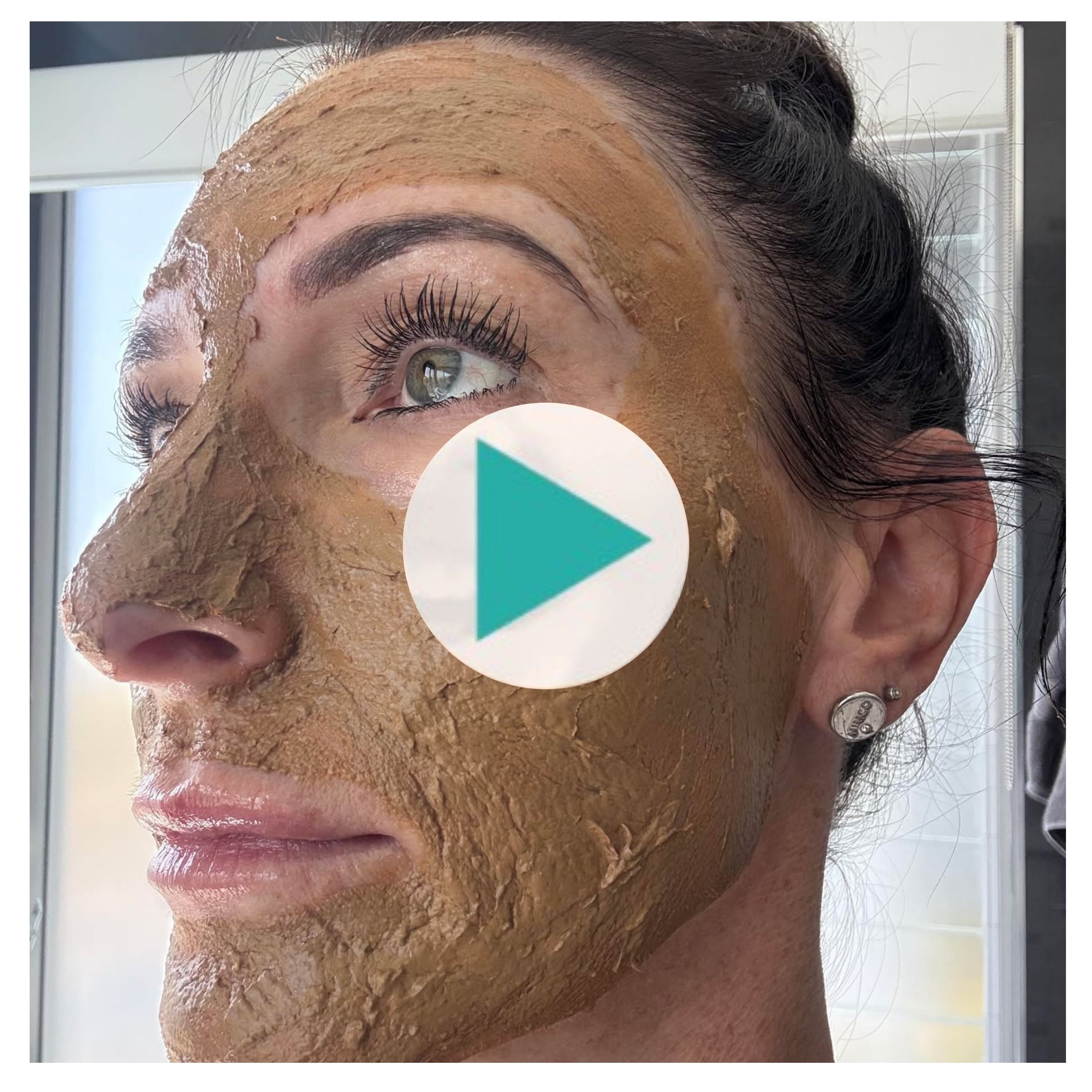 Cosmelan Depigmentation Treatment